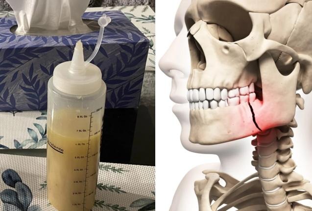 NIYSO: Адам Кадыров после ДТП сломал челюсть и вынужден находиться на жидком режиме питания